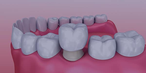A computer-generated image showing how a crown fits over a tooth